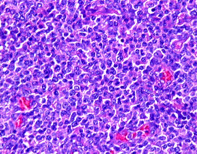 Fig. 17: Linfoma T/NK en tejidos blandos. H-E - <div style=